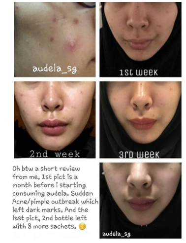 No more acne and pimple