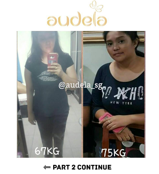 Major weight loss with audela